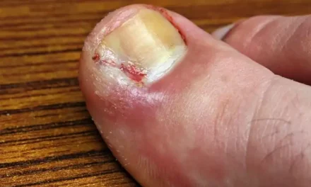 Penumbuhan Kuku Ke Dalam Atau Centengan Membuat Sakit