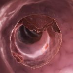 Penyakit Tumor Yang Memakan Jaringan Tubuh