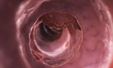 Penyakit Tumor Yang Memakan Jaringan Tubuh