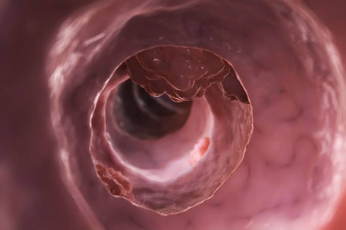 Penyakit Tumor Yang Memakan Jaringan Tubuh